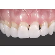 Вініри для зубів верх Snap On Smile