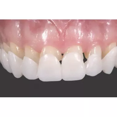 Вініри для зубів верх Snap On Smile Вініри для зубів верх Snap On Smile